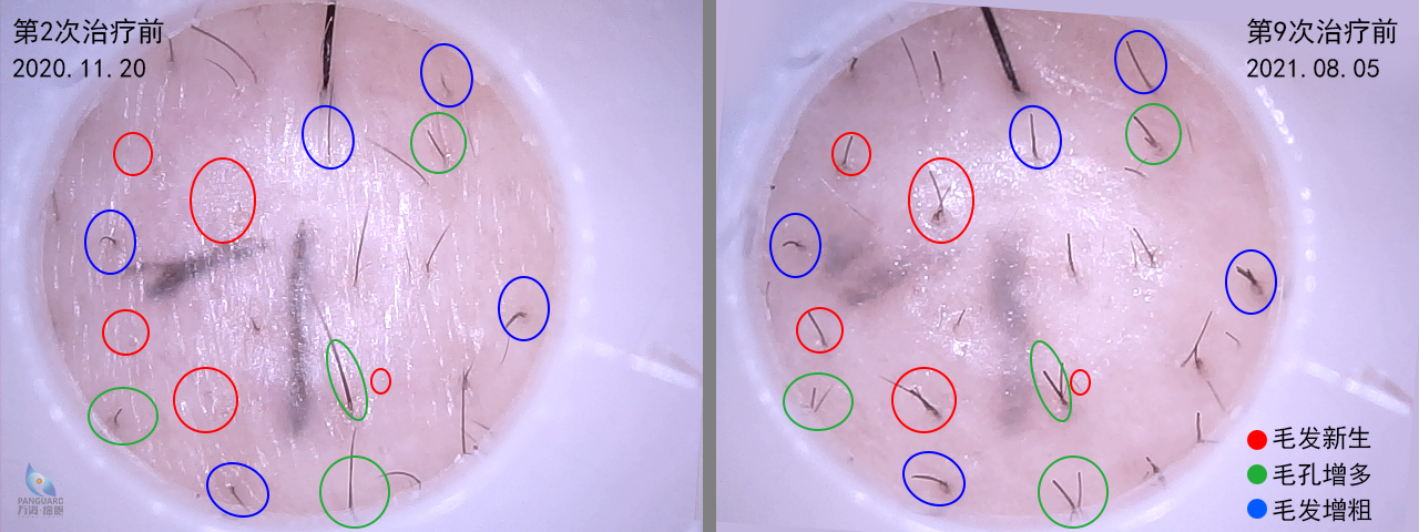 1629251684660481.jpg 生發(fā)治療對照圖3.jpg